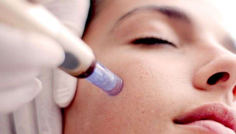 Microneedling auf Mallorca