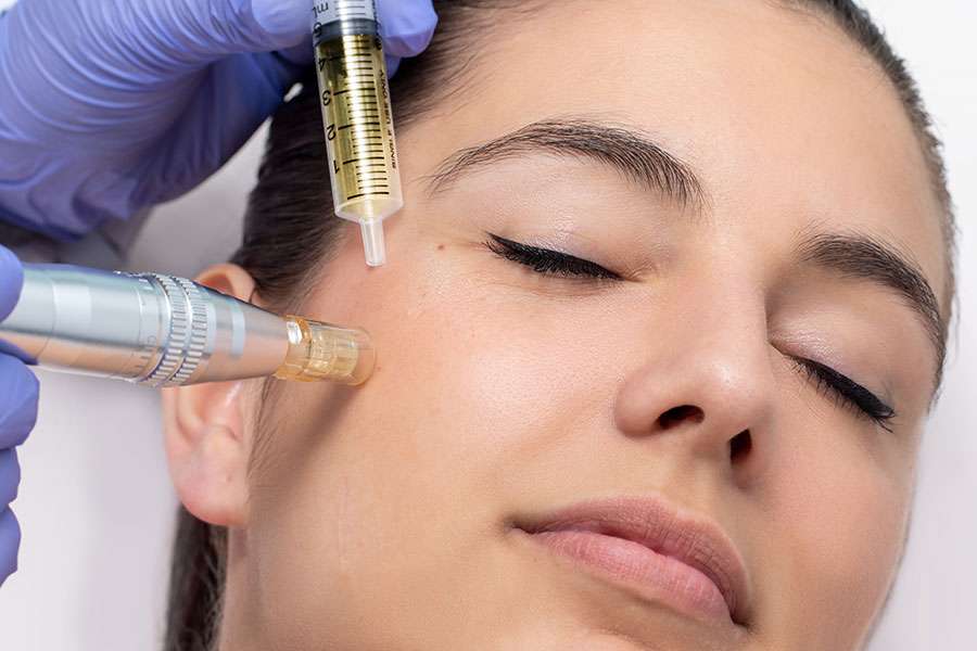Microneedling auf Mallorca